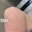 В Красноярске дети покрываются прыщами после прогулки на "свежем" воздухе - Baikal24.Ru