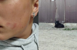В Иркутском районе завели уголовное дело после нападения собаки на школьницу